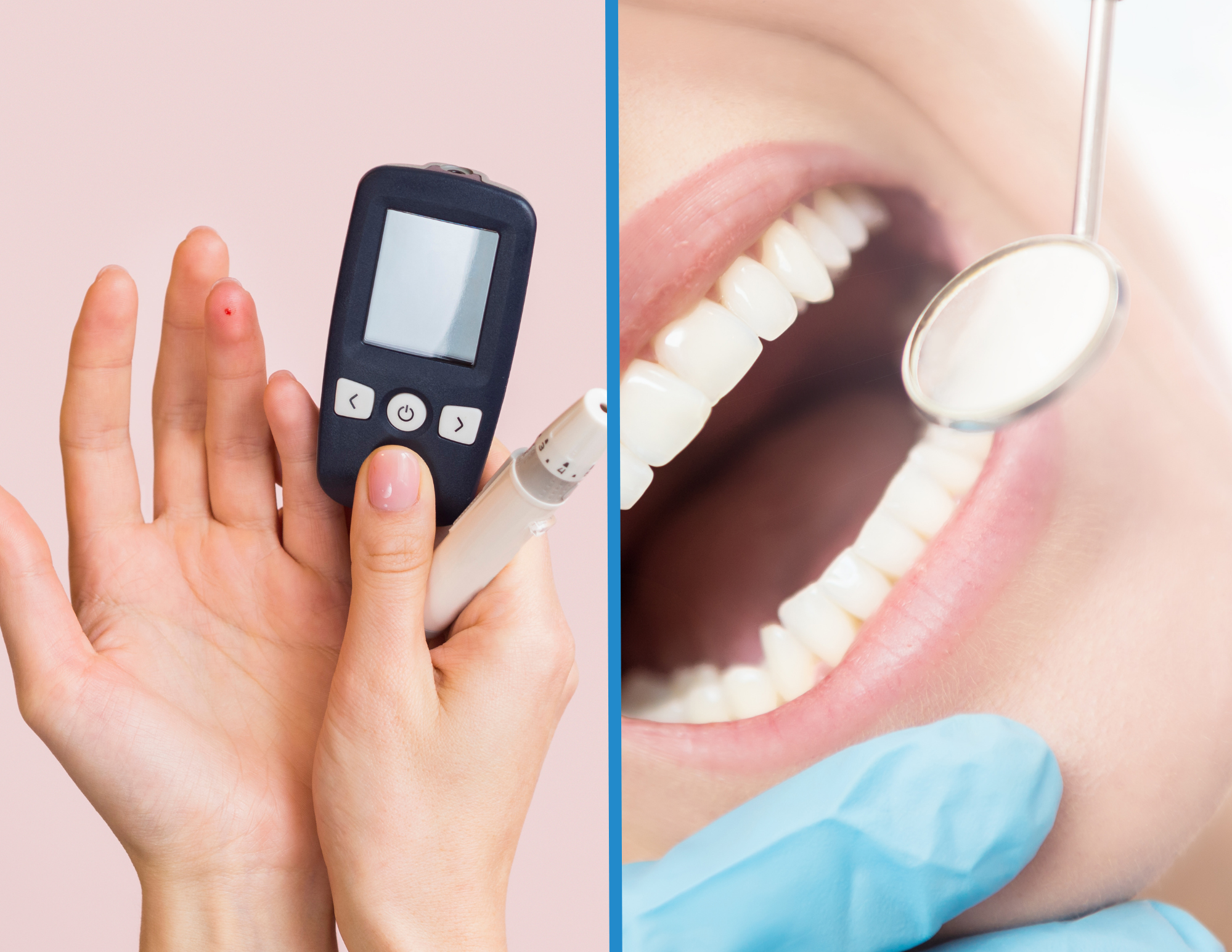 Relazione tra diabete e parodontite: l’infiammazione gengivale può influenzare il controllo glicemico e la salute generale.