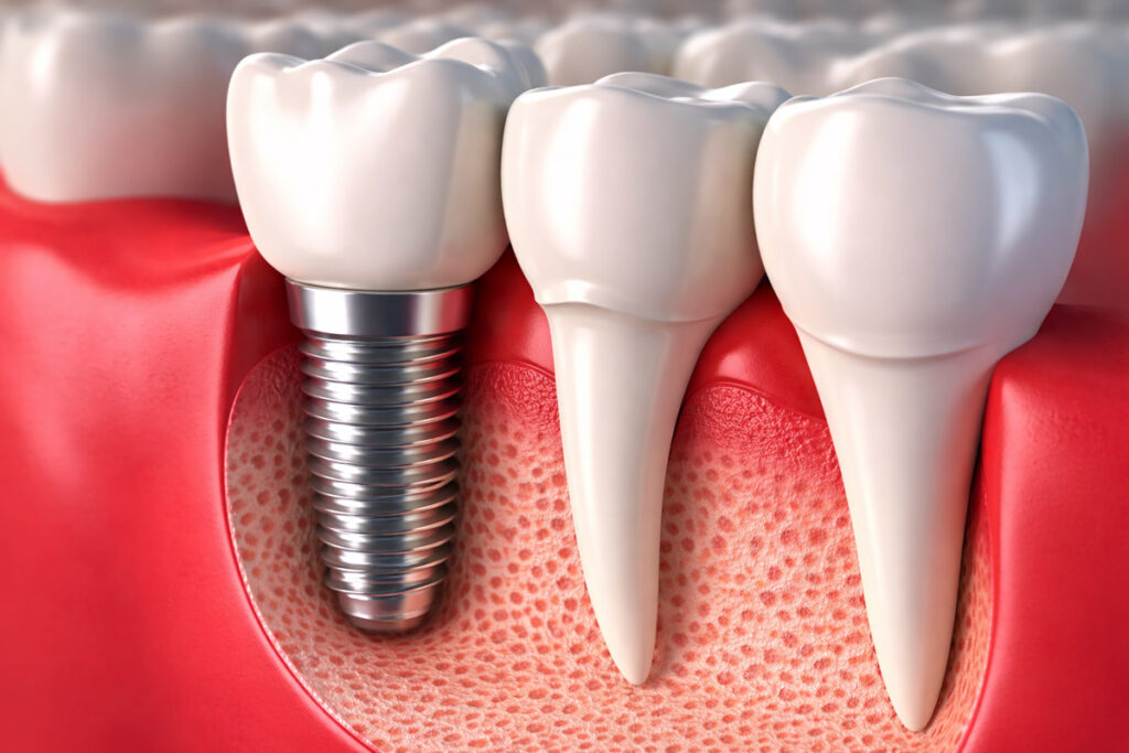 Impianto dentale 3D con chirurgia computer guidata e integrazione nell’osso mascellare in studio odontoiatrico a Inzago